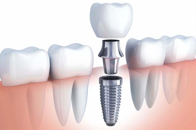 Implants Dentist in Santa Clara